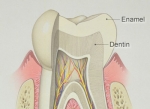 Bệnh viêm tủy răng 