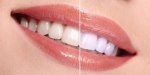 Các câu hỏi về làm trắng răng