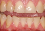 Điều trị mòn răng khó hay dễ?