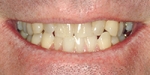 Lấy cao răng có làm răng yếu đi?