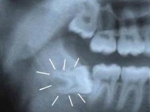 Các phương pháp điều trị răng khôn hàm dưới mọc lệch