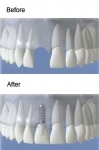 Implant Nha khoa - Hàm răng thứ ba