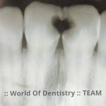 Nguyên nhân sâu răng và cách chữa
